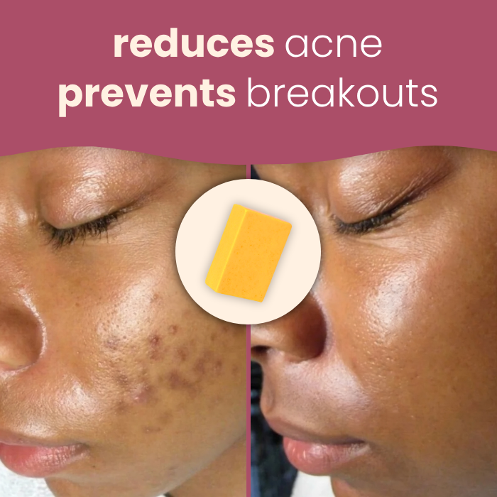 kojic acid & turmeric soap bar