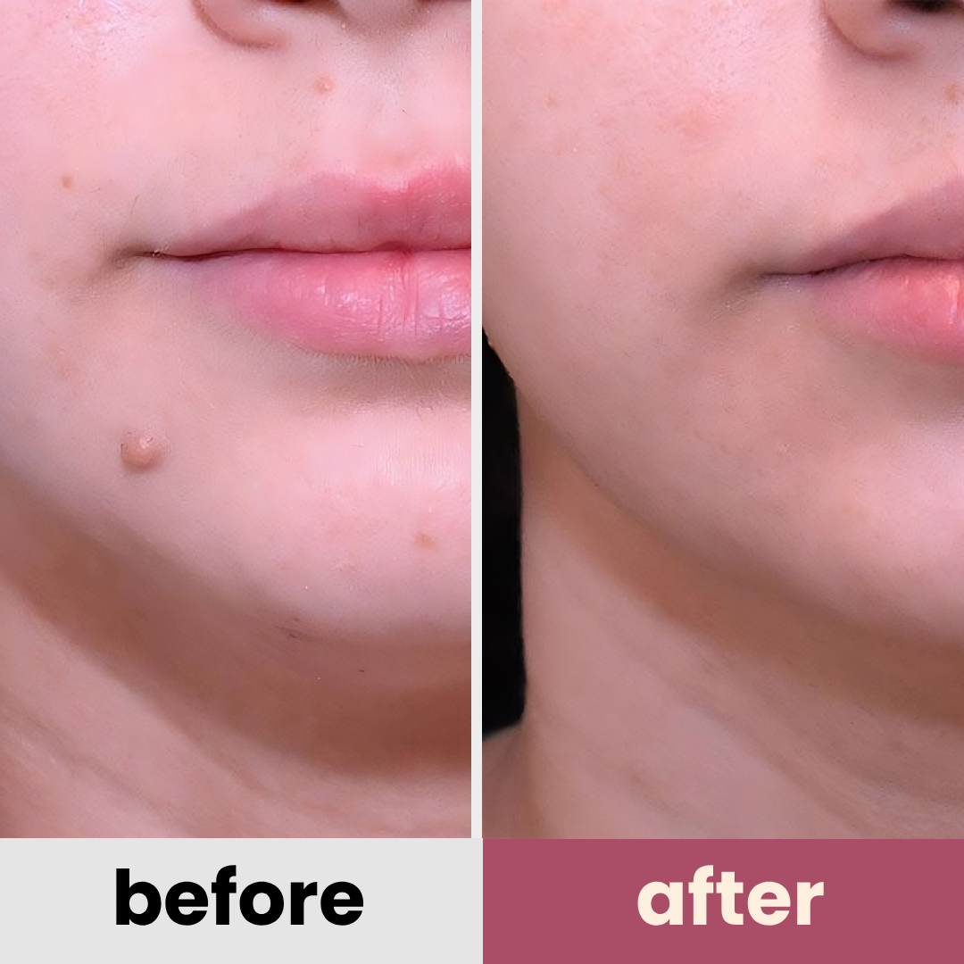 DermaGlow PRO remover pen for moles, age spots, warts & freckles