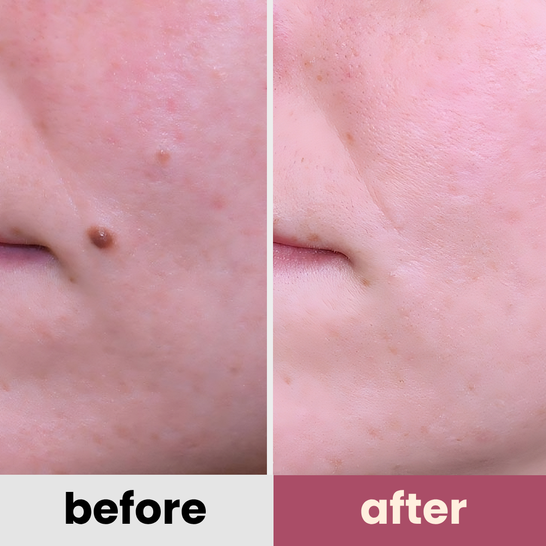 DermaGlow PRO remover pen for moles, age spots, warts & freckles