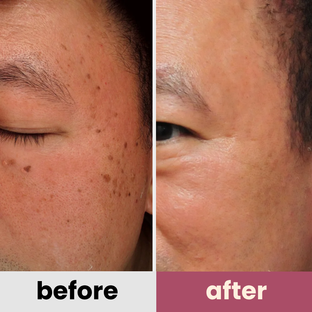 DermaGlow PRO remover pen for moles, age spots, warts & freckles