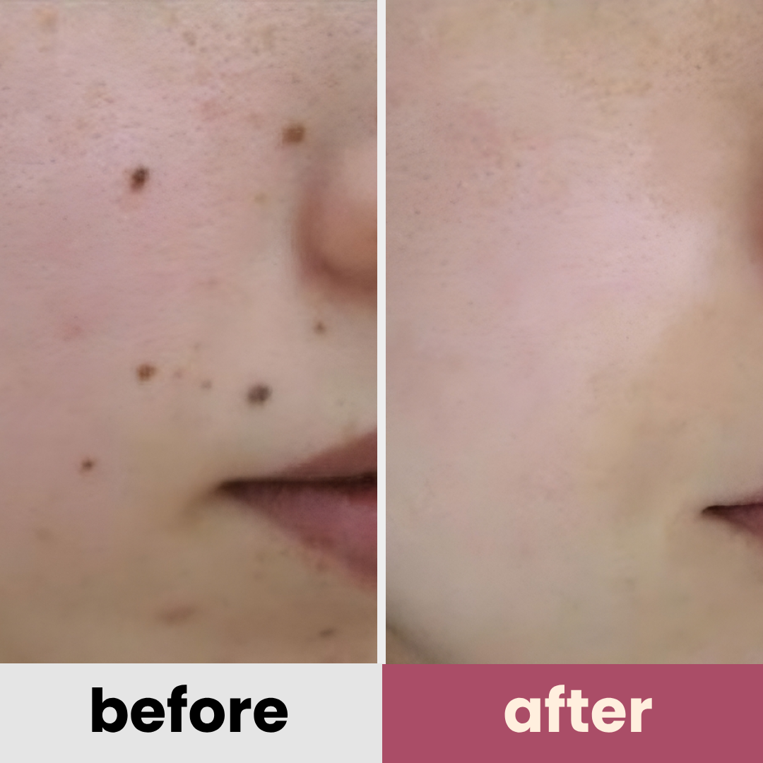 DermaGlow PRO remover pen for moles, age spots, warts & freckles
