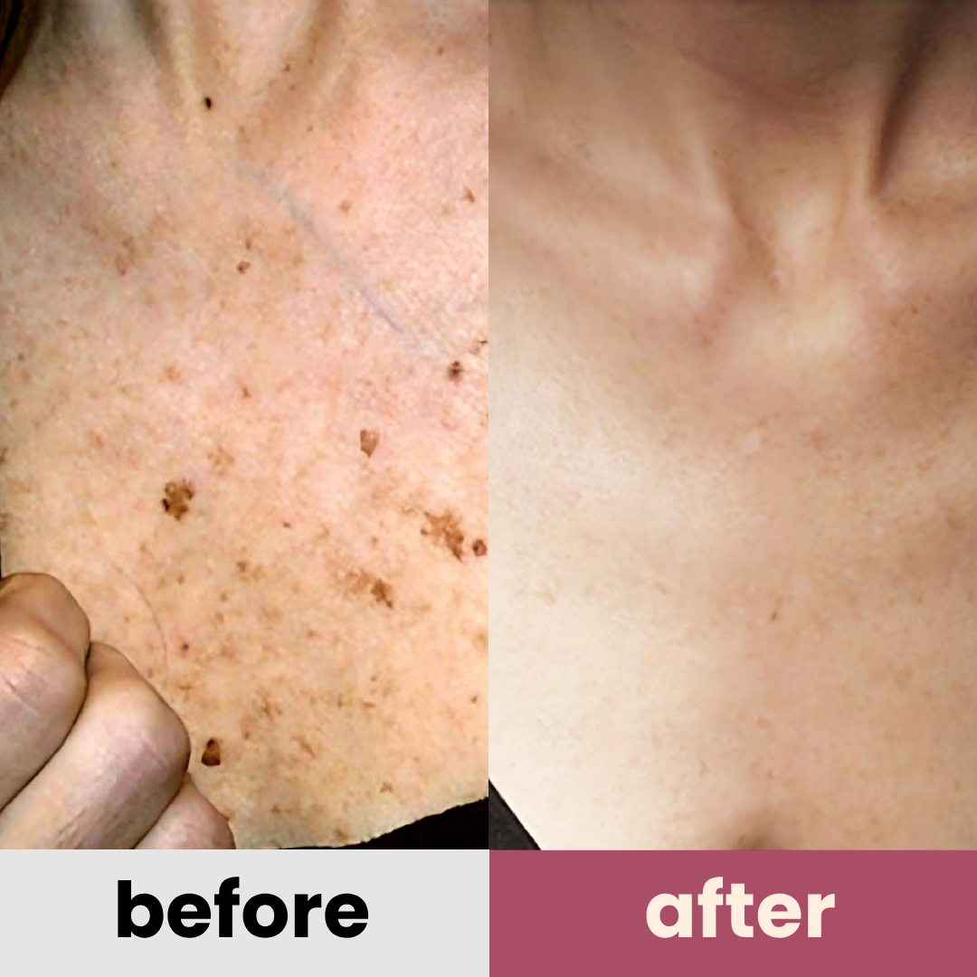 DermaGlow PRO remover pen for moles, age spots, warts & freckles