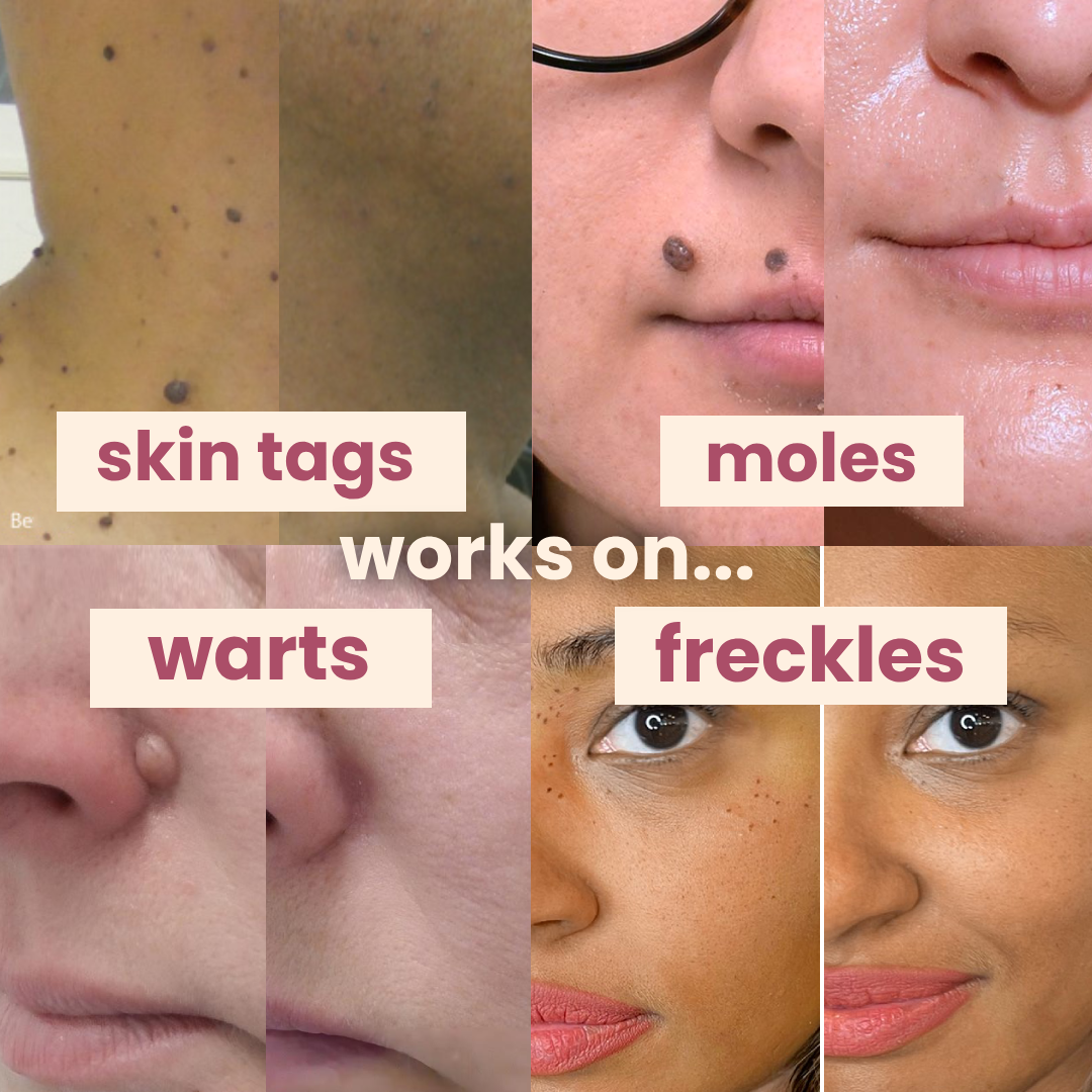 DermaGlow PRO remover pen for moles, age spots, warts & freckles