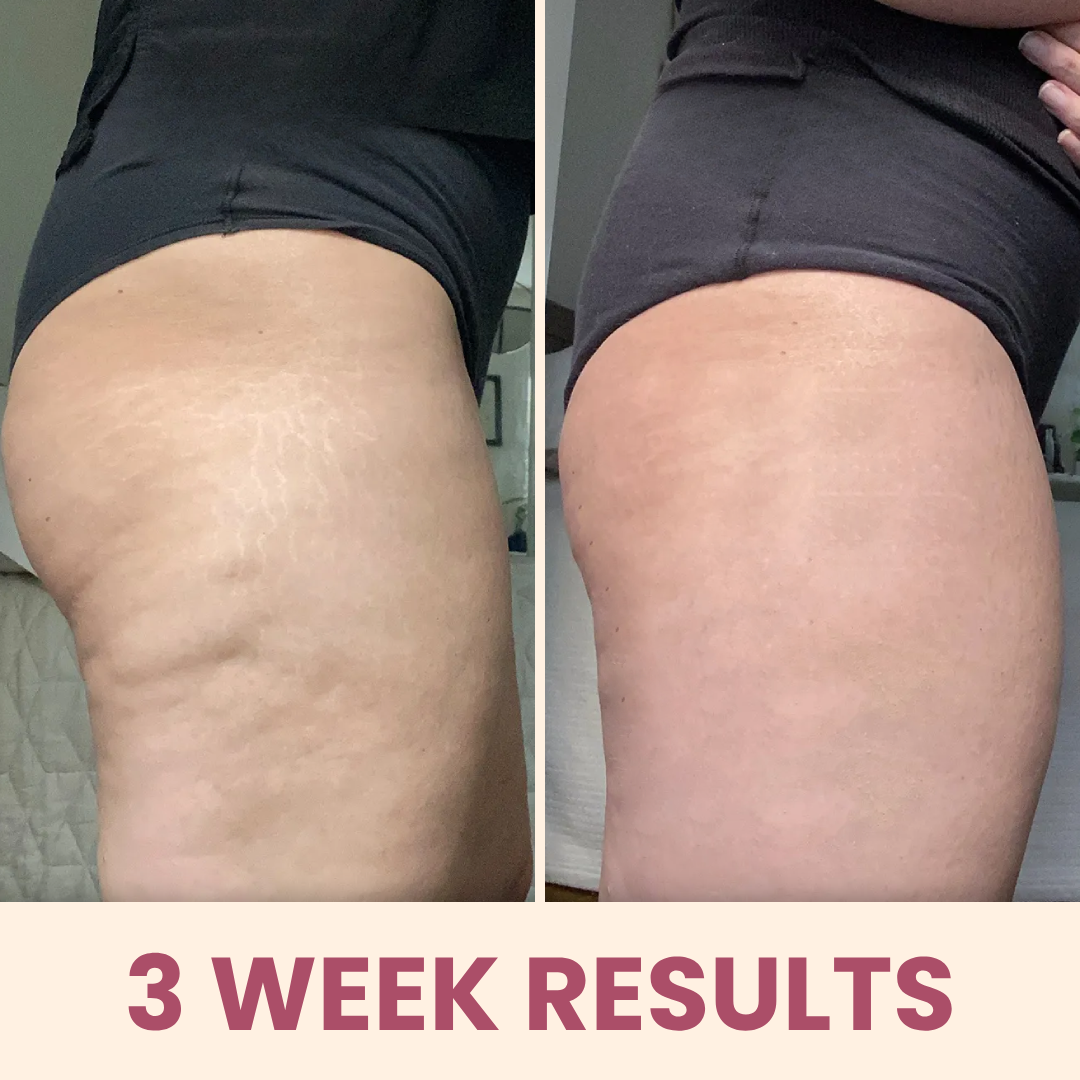 CelBye - cupping & heating massager for cellulite