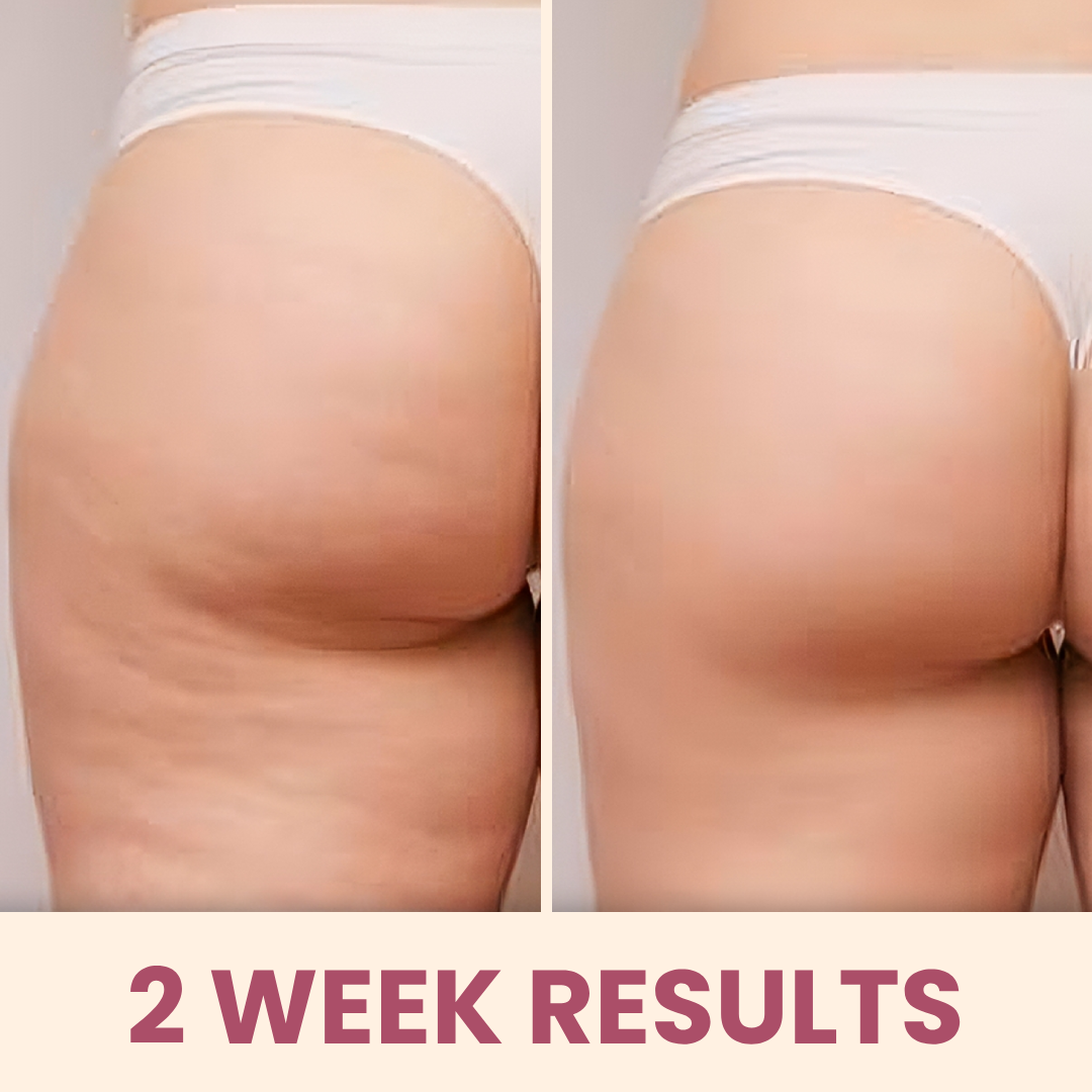 CelBye - cupping & heating massager for cellulite