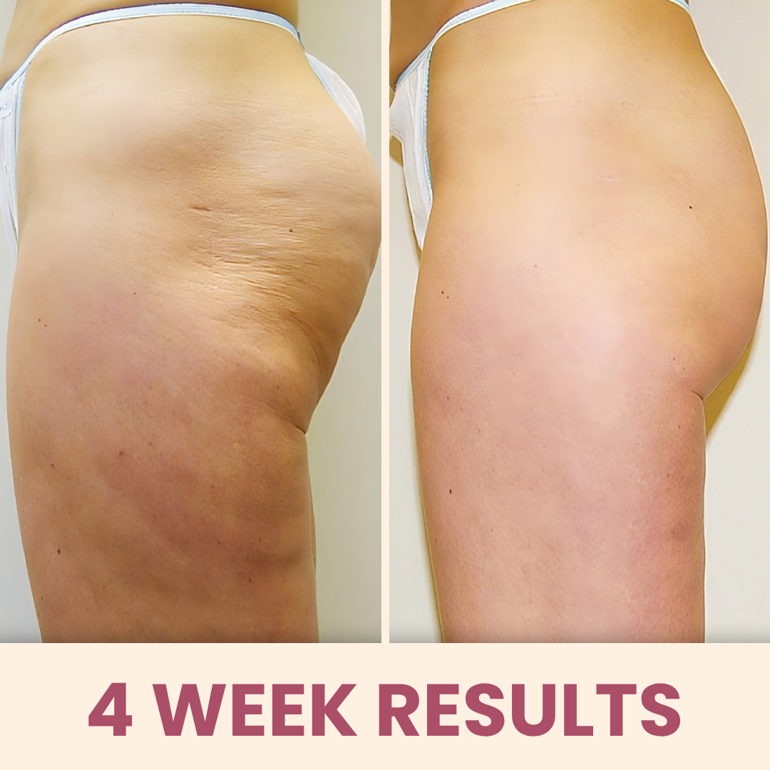 CelBye - cupping & heating massager for cellulite