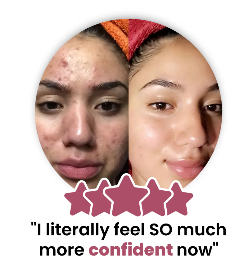 Customer before and after — clearer, more confident skin